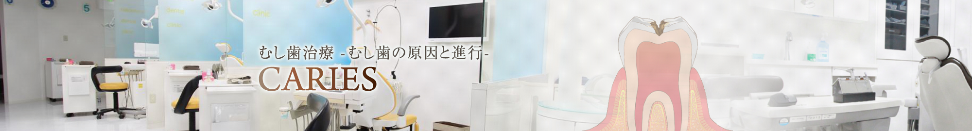 むし歯治療 -むし歯の原因と進行-