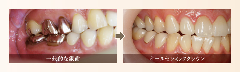 一般的な銀歯→オールセラミッククラウン
