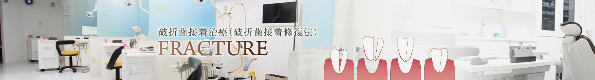 破折歯接着治療(破折歯接着修復法)